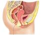 Penyebab dan pengobatan kelalaian uterus, dapatkah kita lakukan tanpa operasi?