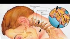 경추의 척추 관절증, 증상 및 치료 근막 증후군이있는 경추의 척추 관절증