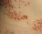 Herpes en la piel: manifestación, síntomas y tratamiento de la erupción cutánea. Qué es el herpes y sus síntomas.