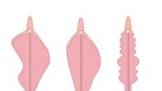 Labios en mujeres: estructura anatómica, indicaciones para labioplastia.