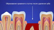 Cosa e come sciacquarsi la bocca dopo l'estrazione del dente: raccomandazioni